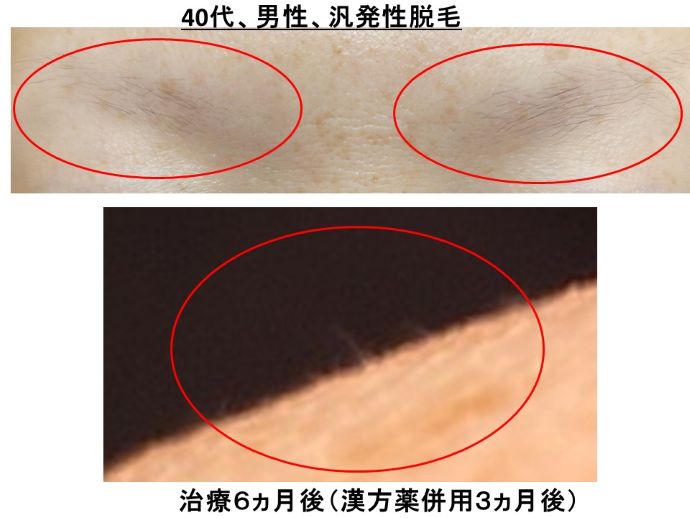 円形脱毛症　病院